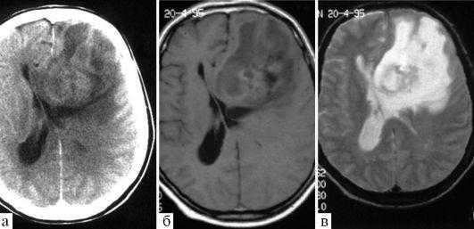 Снимки МРТ и КТ. Пилоцитарная астроцитома