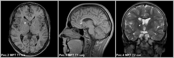 subependimarnaya-gigantokletochnaya-astrotsitoma-2