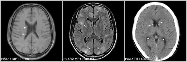 subependimarnaya-gigantokletochnaya-astrotsitoma-5
