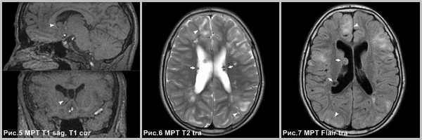 subependimarnaya-gigantokletochnaya-astrotsitoma-3
