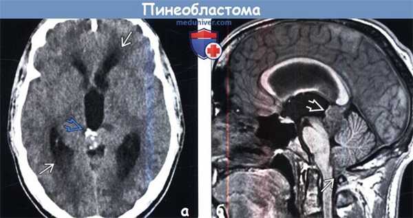Пинеобластома на КТ, МРТ