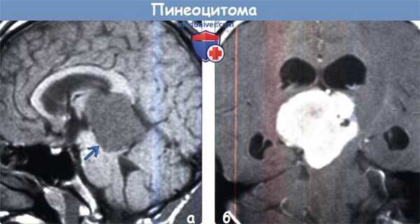 Пинеоцитома на МРТ