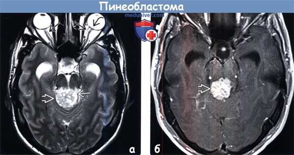 Пинеобластома на МРТ