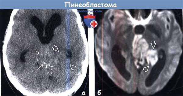 Пинеобластома на КТ, МРТ