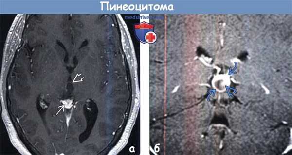 Пинеоцитома на МРТ