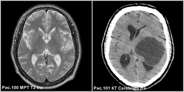 pleomorphic_xanthoastrositoma_1