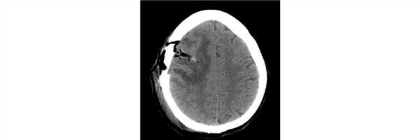 Успешное хирургическое лечение анапластической плеоморфной ксантоастроцитомы