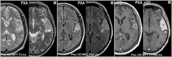 pleomorphic_xanthoastrositoma_8