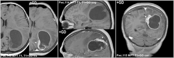 pleomorphic_xanthoastrositoma_5