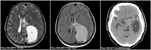 pleomorphic_xanthoastrositoma_2