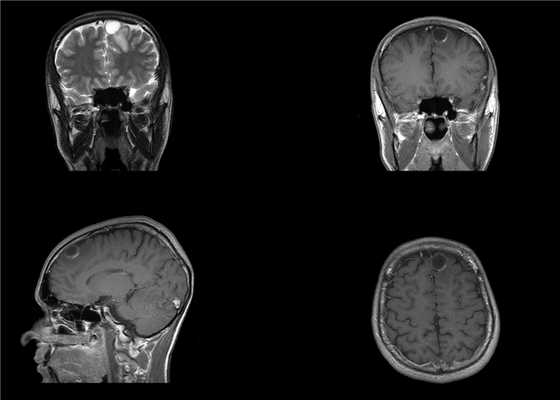 МРТ признаки плеоморфной ксантоастроцитомы