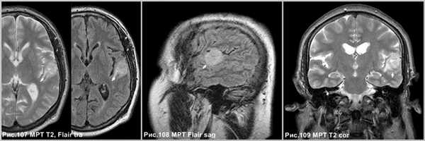 pleomorphic_xanthoastrositoma_3