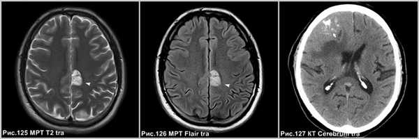 pleomorphic_xanthoastrositoma_9