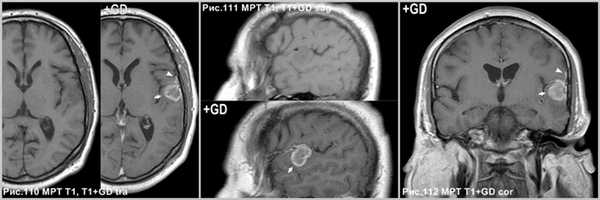 pleomorphic_xanthoastrositoma_4