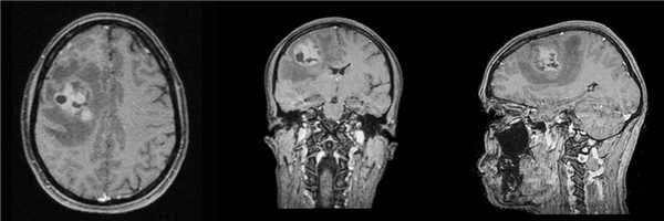 МРТ признаки анапластической плеоморфной ксантоастроцитомы