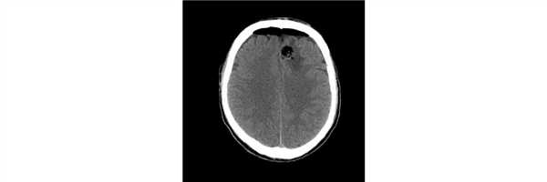 Успешное хирургическое лечение плеоморфной ксантоастроцитомы