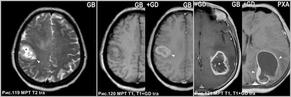 pleomorphic_xanthoastrositoma_7