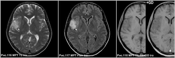 pleomorphic_xanthoastrositoma_6