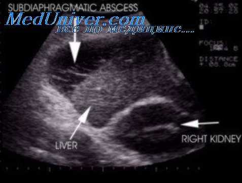 поддиафрагмальный абсцесс