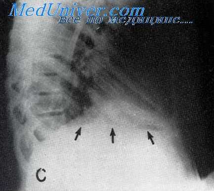 поддиафрагмальный абсцесс