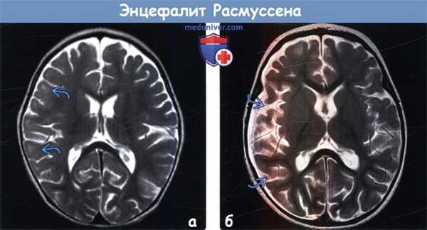 Энцефалит Расмуссена на МРТ