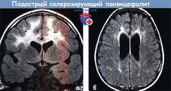 Подострый склерозирующий панэнцефалит на МРТ