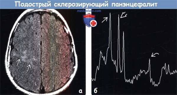 Подострый склерозирующий панэнцефалит на МРТ