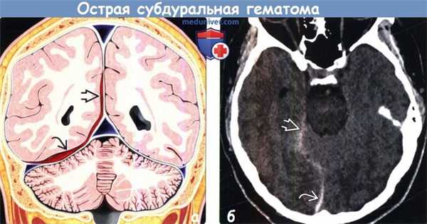 Острая субдуральная гематома на КТ