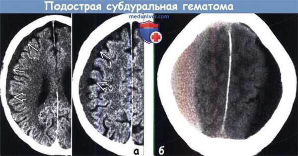 Подострая субдуральная гематома на КТ