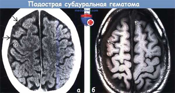 Подострая субдуральная гематома на КТ, МРТ