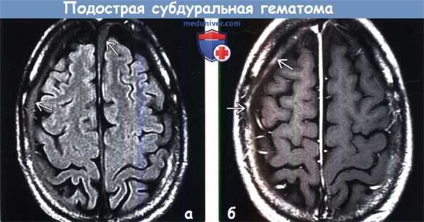 Подострая субдуральная гематома на МРТ
