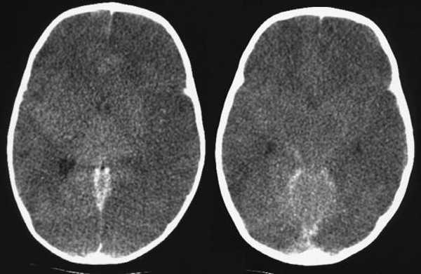 отек гм кт.jpg