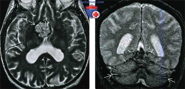 КТ, МРТ при поверхностном сидерозе мостомозжечкового угла (ММУ) и внутреннего слухового канала (ВСК)