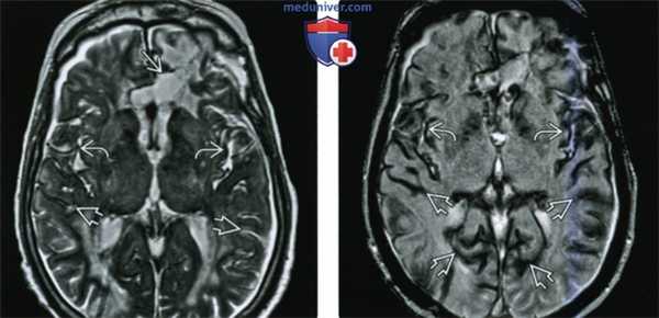 КТ, МРТ при поверхностном сидерозе мостомозжечкового угла (ММУ) и внутреннего слухового канала (ВСК)