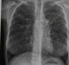 Снимки МРТ и КТ. Муковисцидоз (кистозный фиброз)