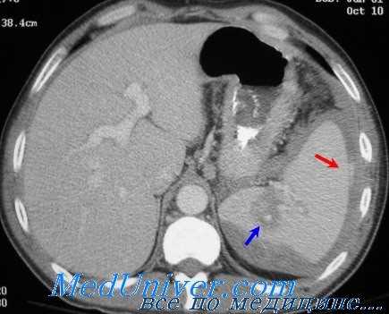 КТ при повреждении селезенки