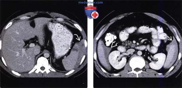 Рентгенограмма, КТ, УЗИ при повреждении селезенки