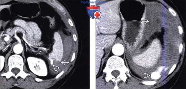 Рентгенограмма, КТ, УЗИ при повреждении селезенки