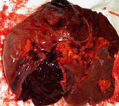 Разрыв селезенки