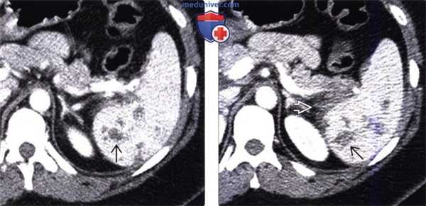 Рентгенограмма, КТ, УЗИ при повреждении селезенки