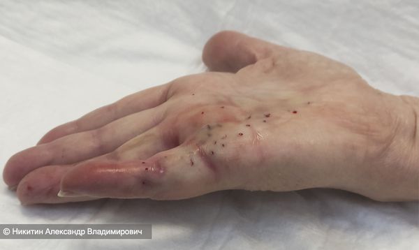 Игольная фасциотомия