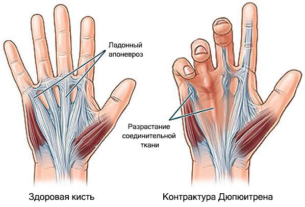 Контрактура Дюпюитрена