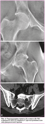Рис. 2. Рентгенограммы правого (А) и левого (B) ТБС и данные КТ КПС (С) пациента Ч. при поступлении в клинику факультетской терапии
