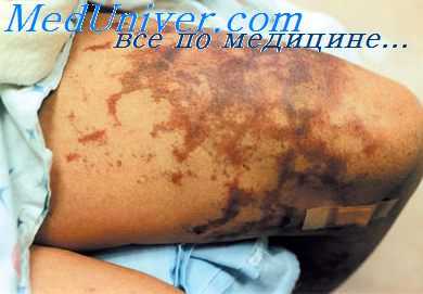 геморрагическая сыпь