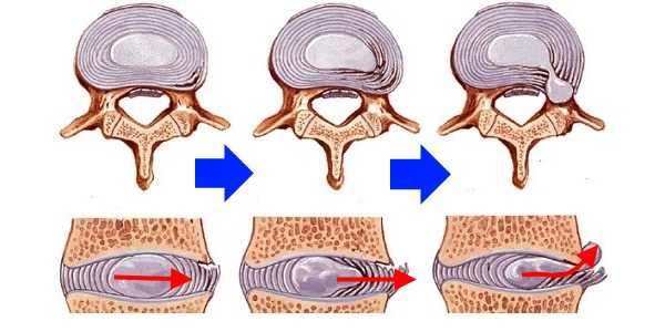 При грыже позвоночника пульпозное ядро диска выдавливается через трещины, образовавшиеся в фиброзном кольце