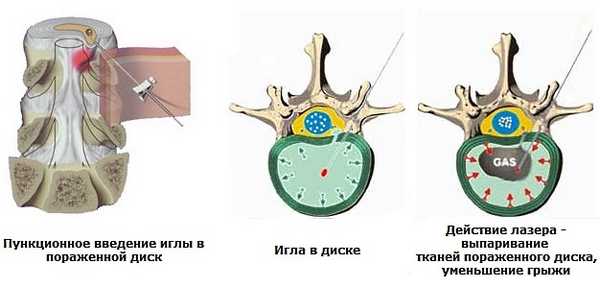 При лазерной вапоризации выпаривается влага из диска, уменьшается его объем и следовательно давление на нервные окончания