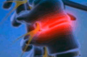 Пункционная лазерная денуклеация или вапоризация межпозвонковых дисков - это современный и высокоэффективный метод лечения грыжи межпозвонковых дисков. Лазерное удаление показано пациентам с грыжами в любом отделе позвоночника. Благодаря данному методу м