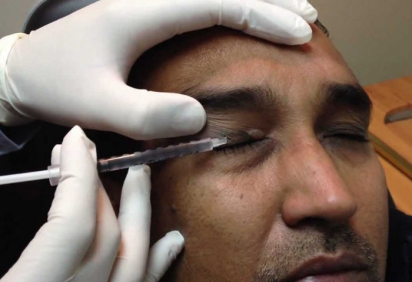 Введение ботулотоксина