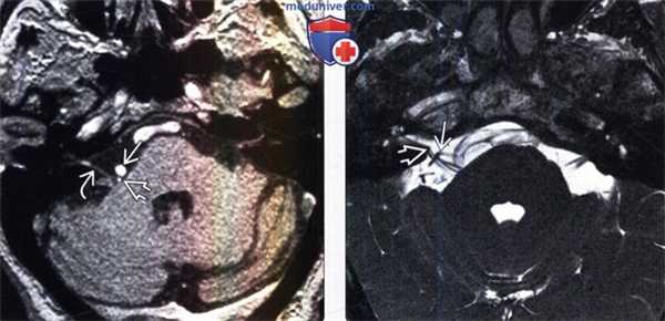 МРТ при гемифациальном спазме