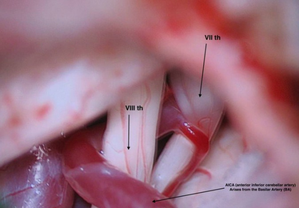 Гемифациальный спазм